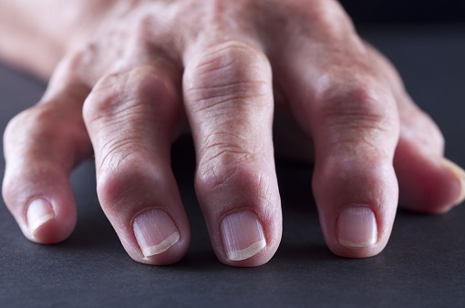 arthrose doigts