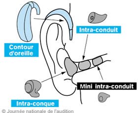Les prothèses auditives